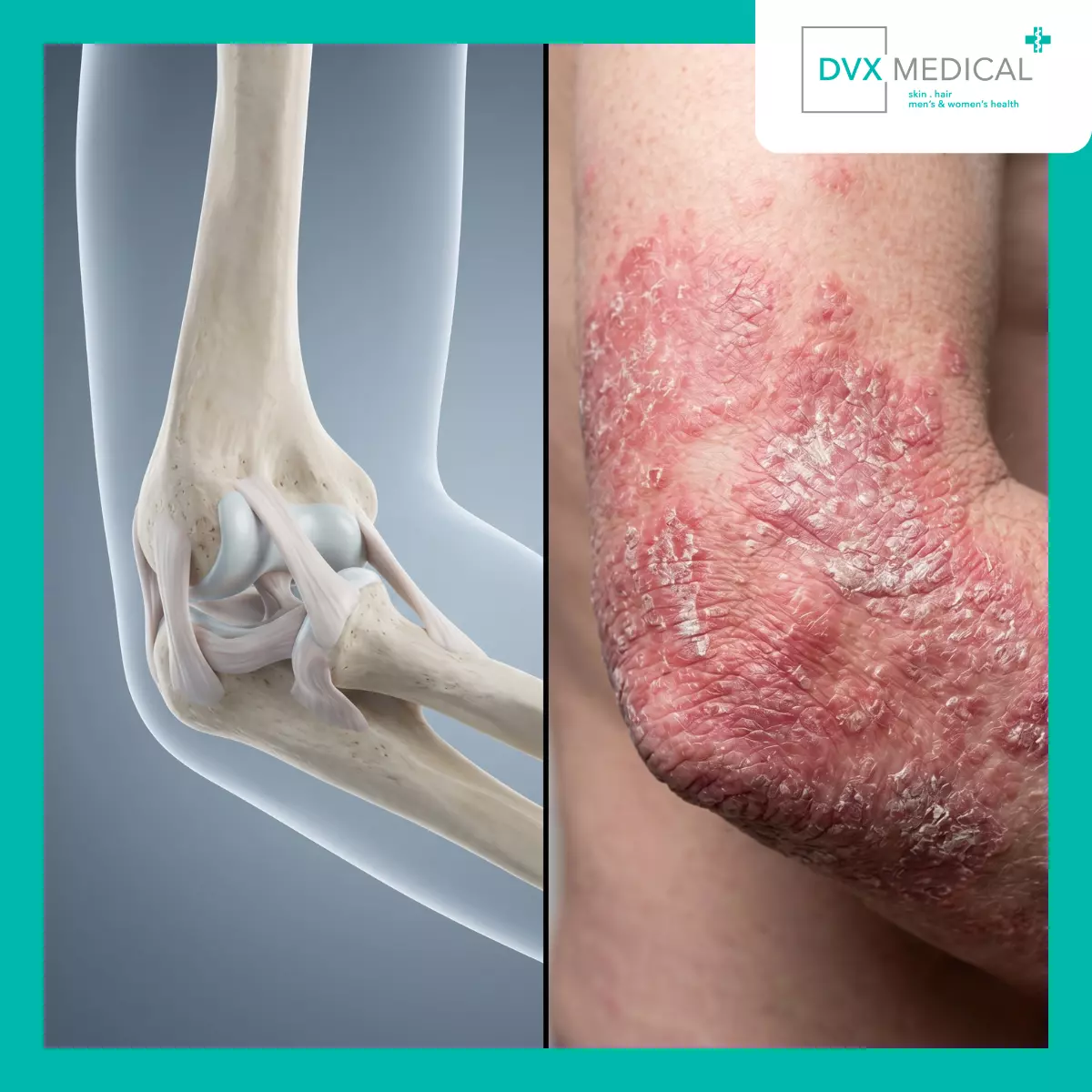 Apa yang Dimaksud dengan Psoriasis dengan Keterlibatan Sendi?