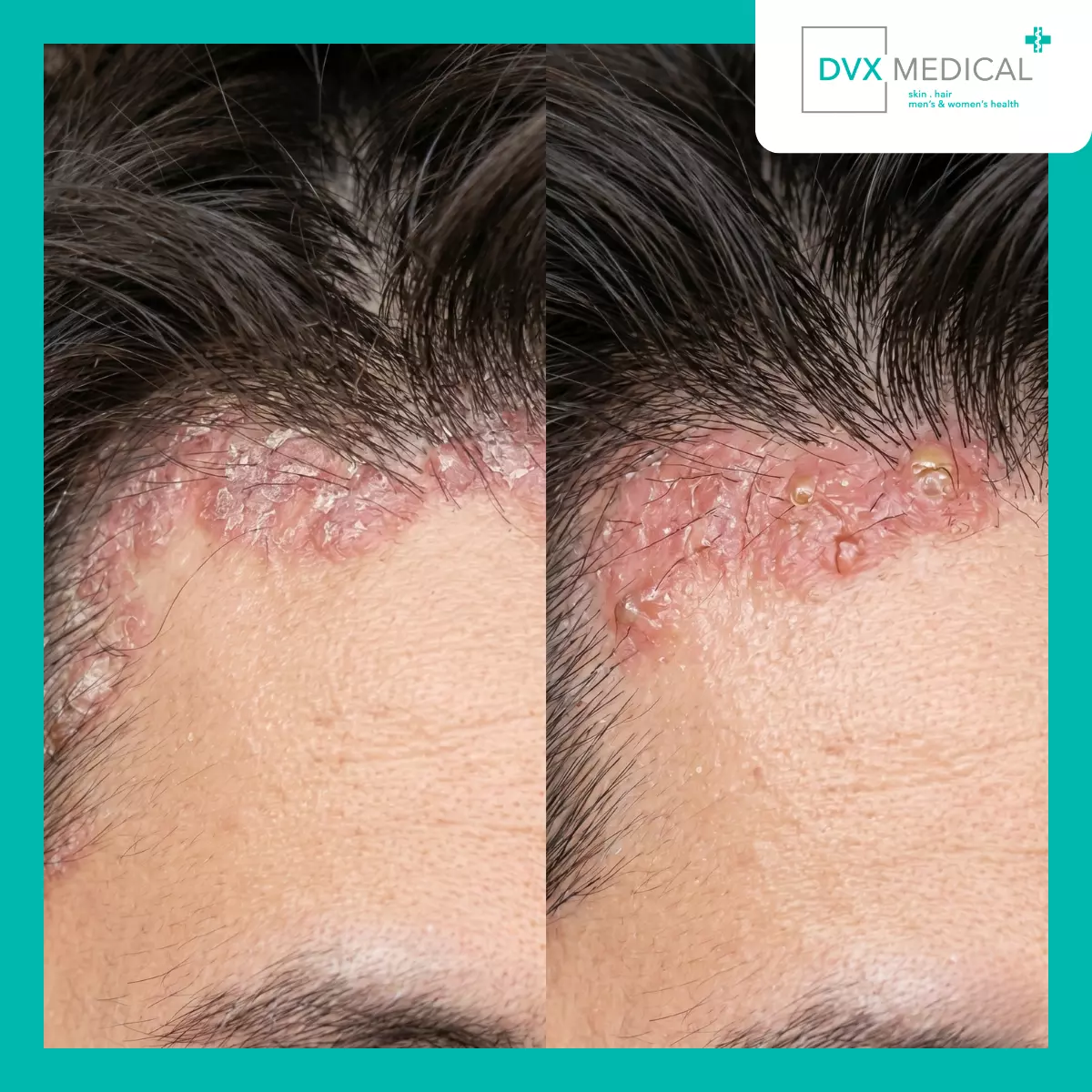 Apa yang Membuat Psoriasis Berbeda dari Eksim?