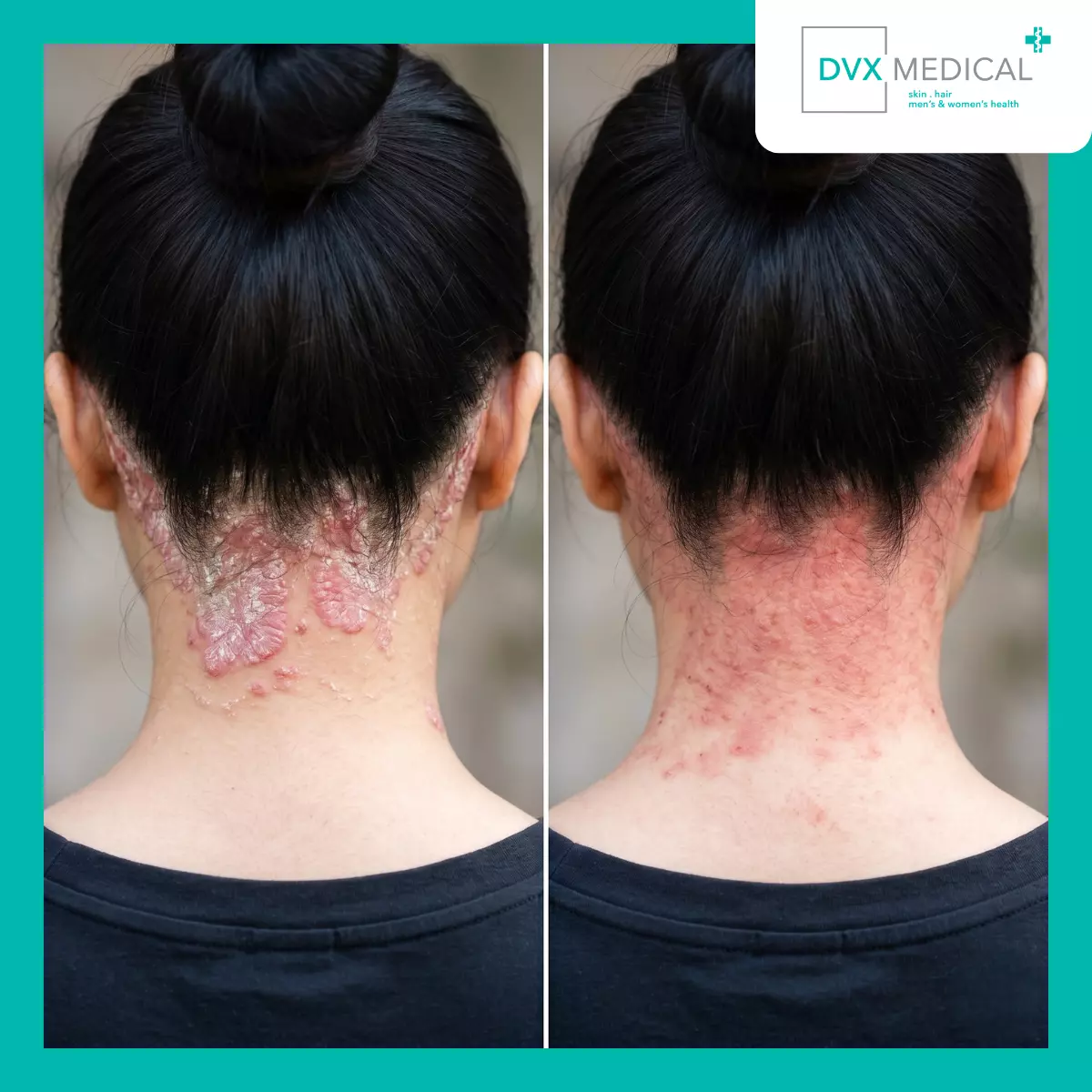 Mengapa Psoriasis Tidak Berperilaku Seperti Ruam Kulit Biasa?
