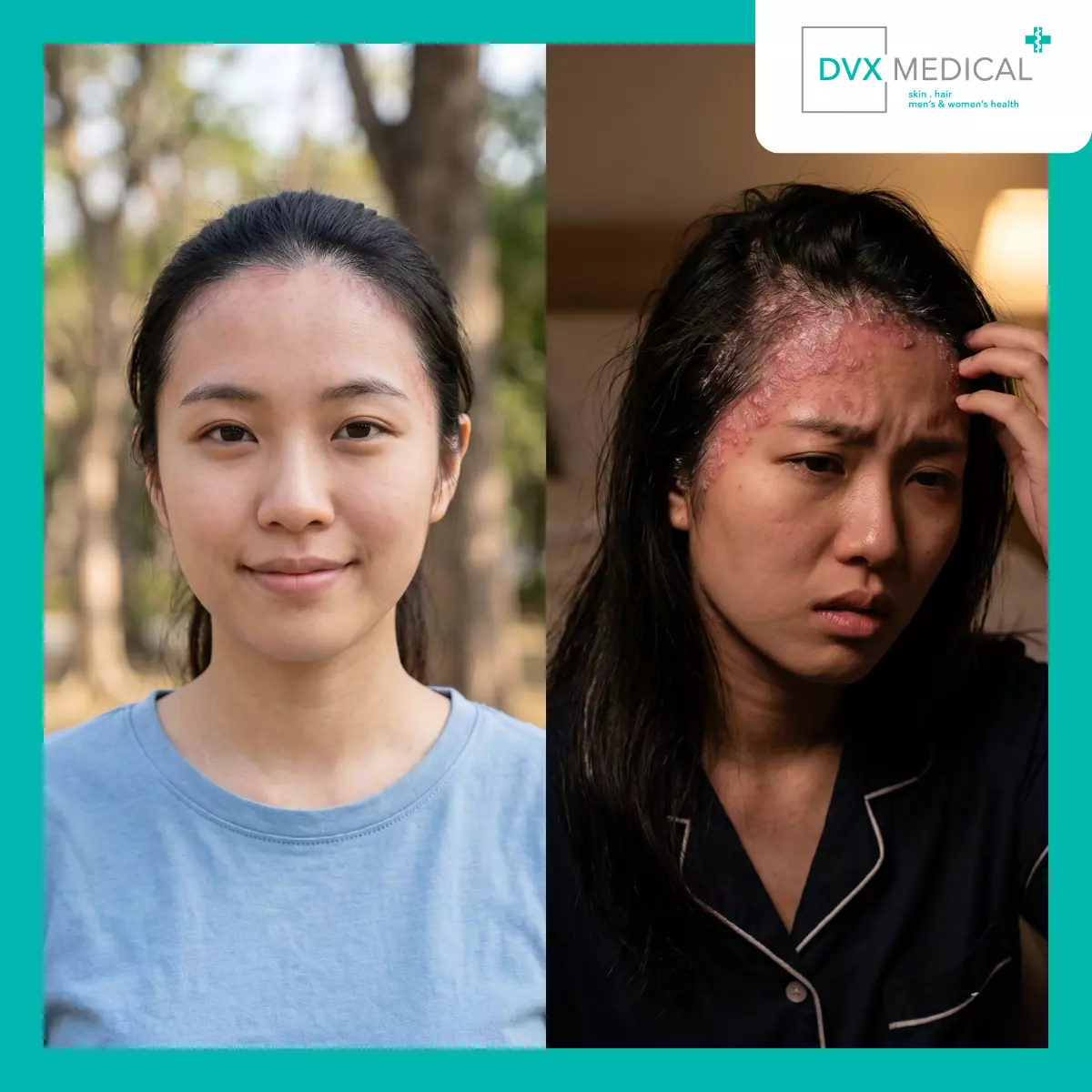 Mengapa Psoriasis Bisa Membaik dan Memburuk pada Waktu yang Berbeda?