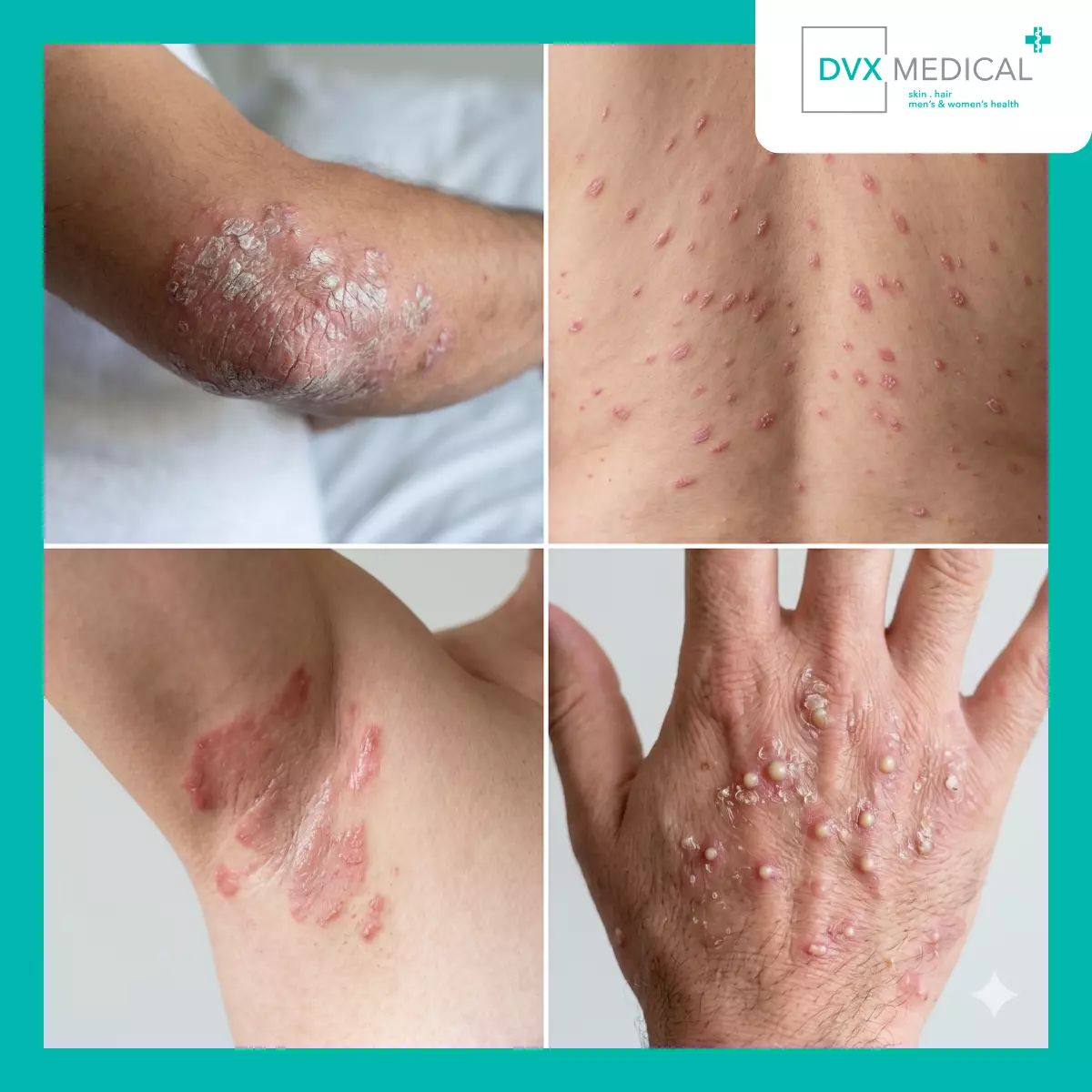 Gejala Psoriasis Berdasarkan Lokasi