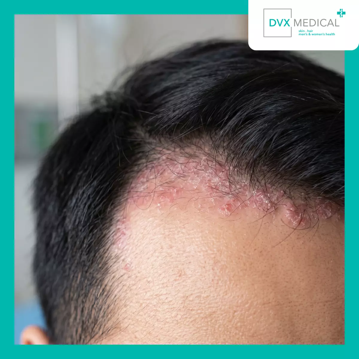 Kapan Gejala yang Tampak di Kulit Layak Dicurigai sebagai Psoriasis?