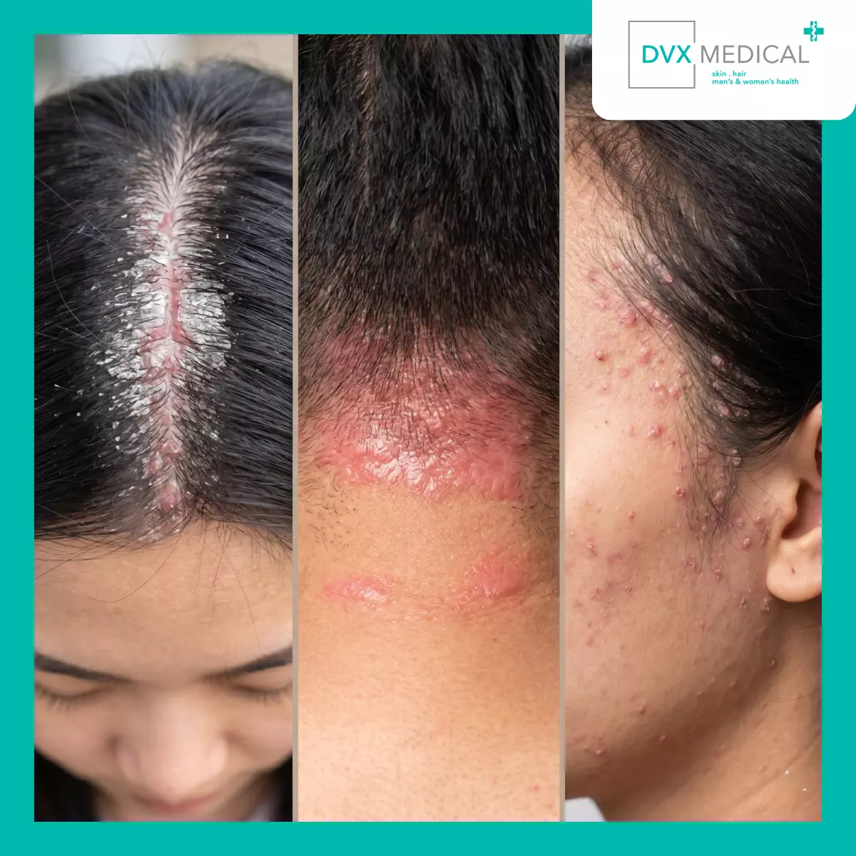 Mengapa Psoriasis Bisa Terlihat Berbeda pada Setiap Orang?