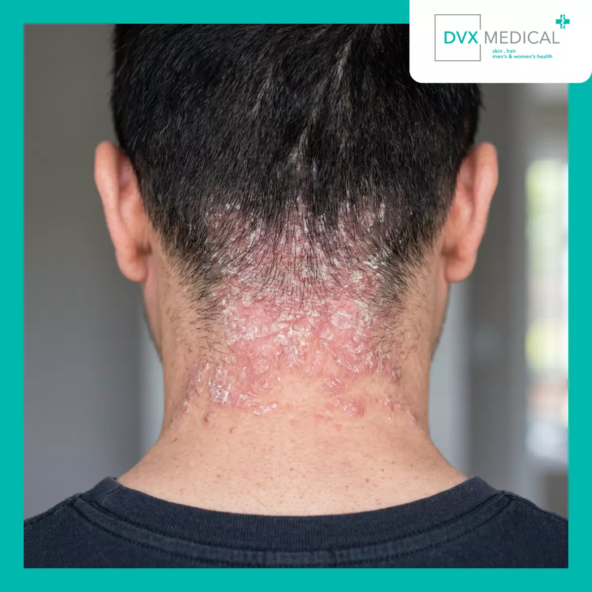 Psoriasis Plak: Bentuk yang Paling Sering Ditemukan