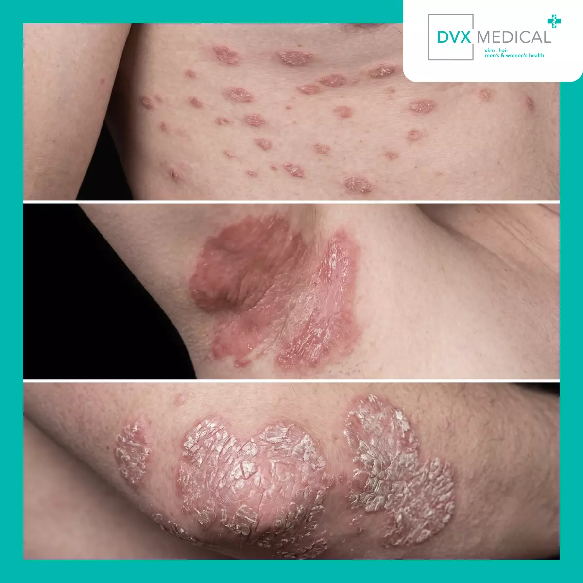 Jenis Psoriasis yang Sering Membingungkan Pasien