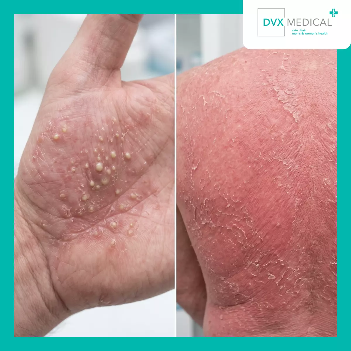 Jenis Psoriasis yang Lebih Jarang tetapi Perlu Dikenali