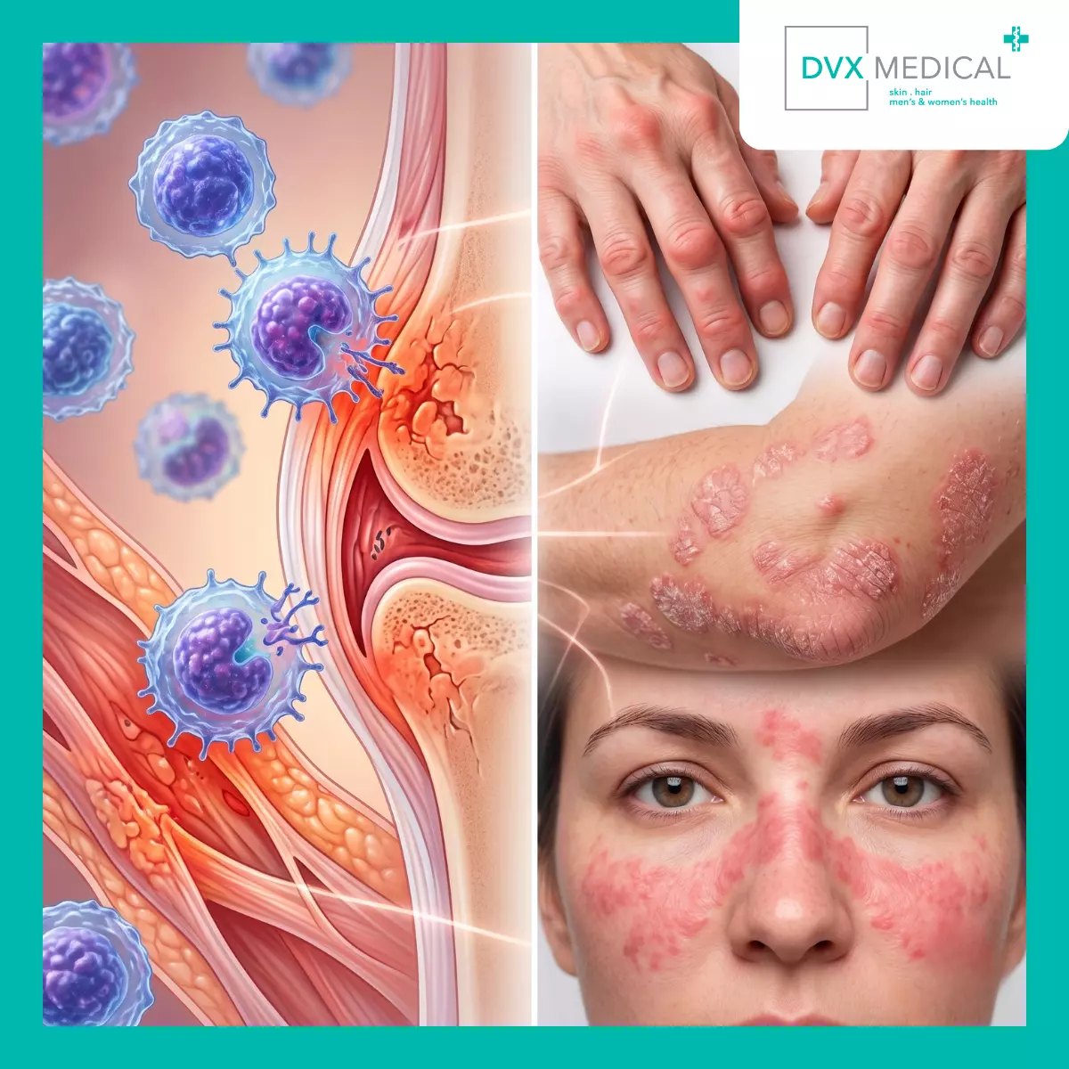 Mengapa Psoriasis Digolongkan sebagai Penyakit Autoimun?