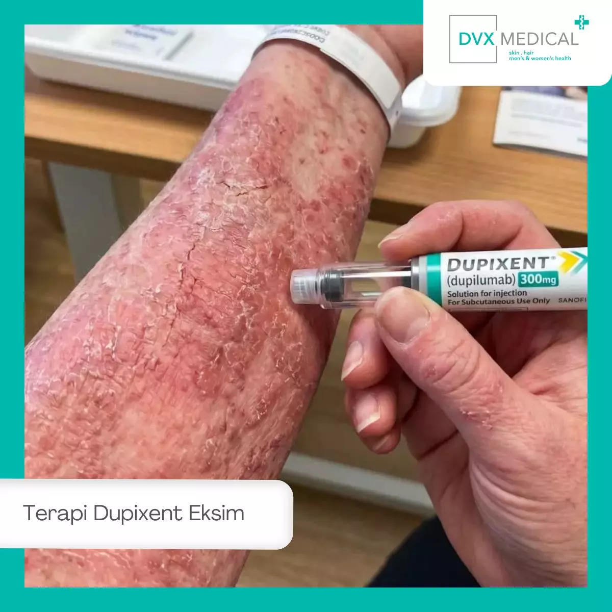 Terapi Dupixent di DVX Medical untuk Eksim