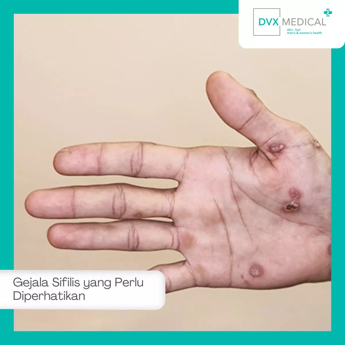 Gejala Sifilis yang Perlu Diperhatikan