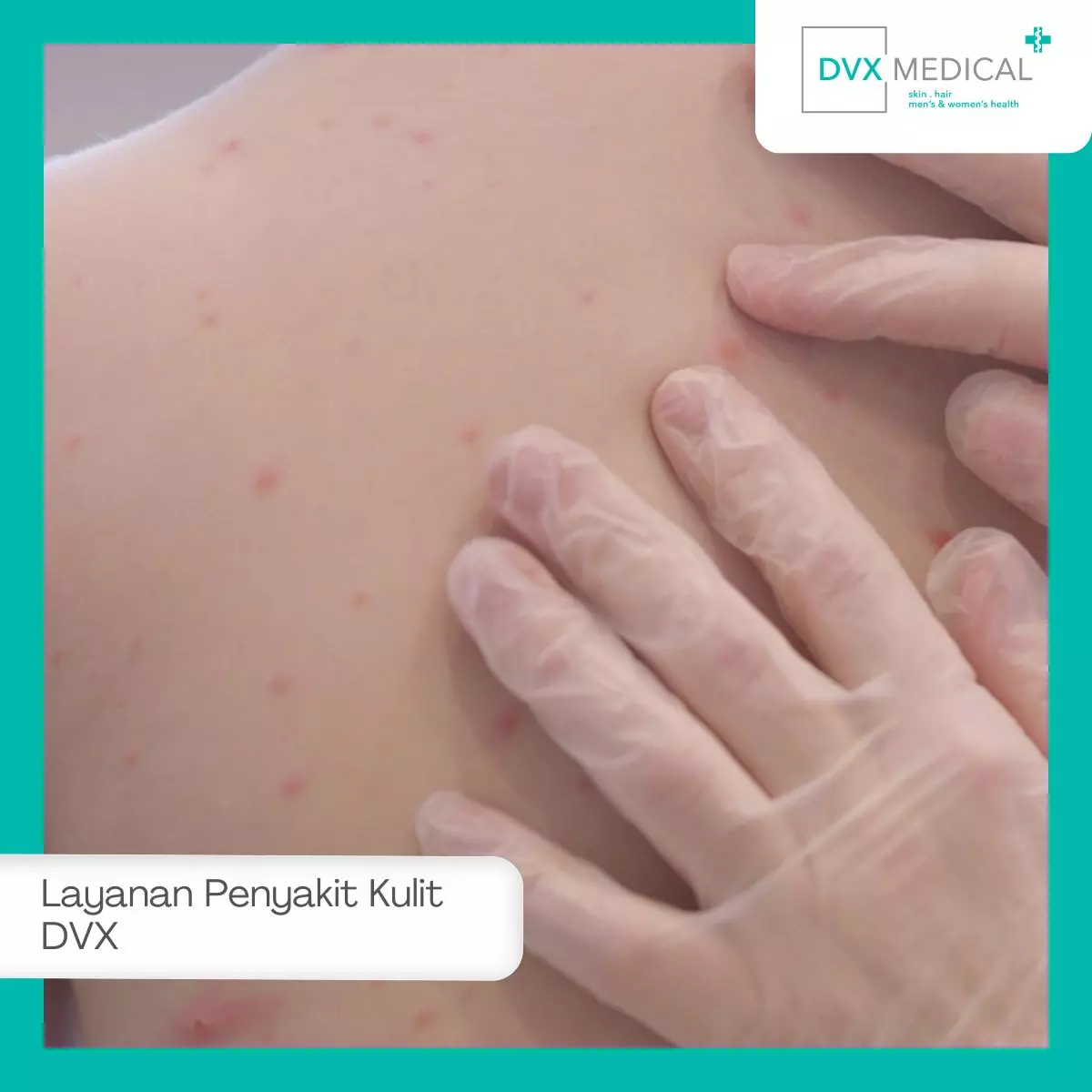 Berbagai Penyakit Kulit yang Dapat Ditangani di Klinik Dermatologi Surabaya DVX Medical