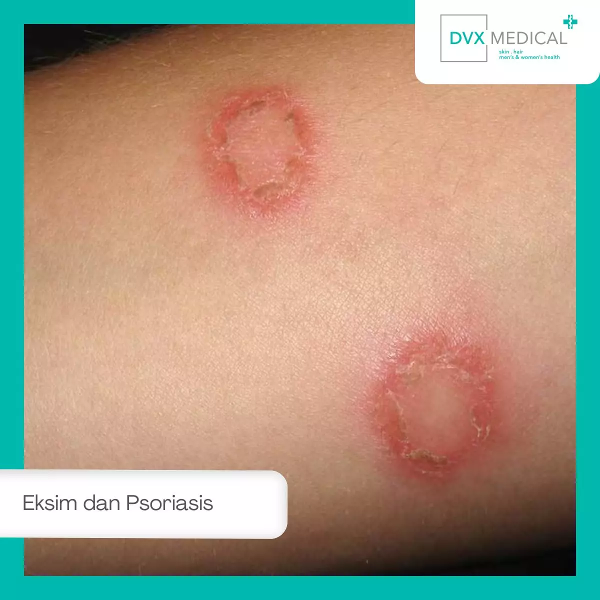 Apa Itu Eksim dan Psoriasis? Kenali Dua Penyakit Kulit yang Sering Tertukar