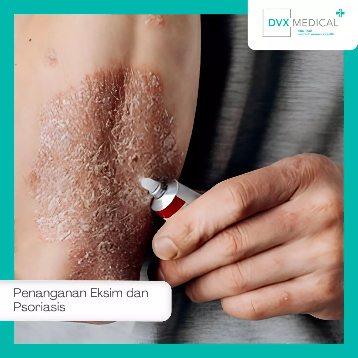 Penanganan Eksim dan Psoriasis di DVX Medical Surabaya