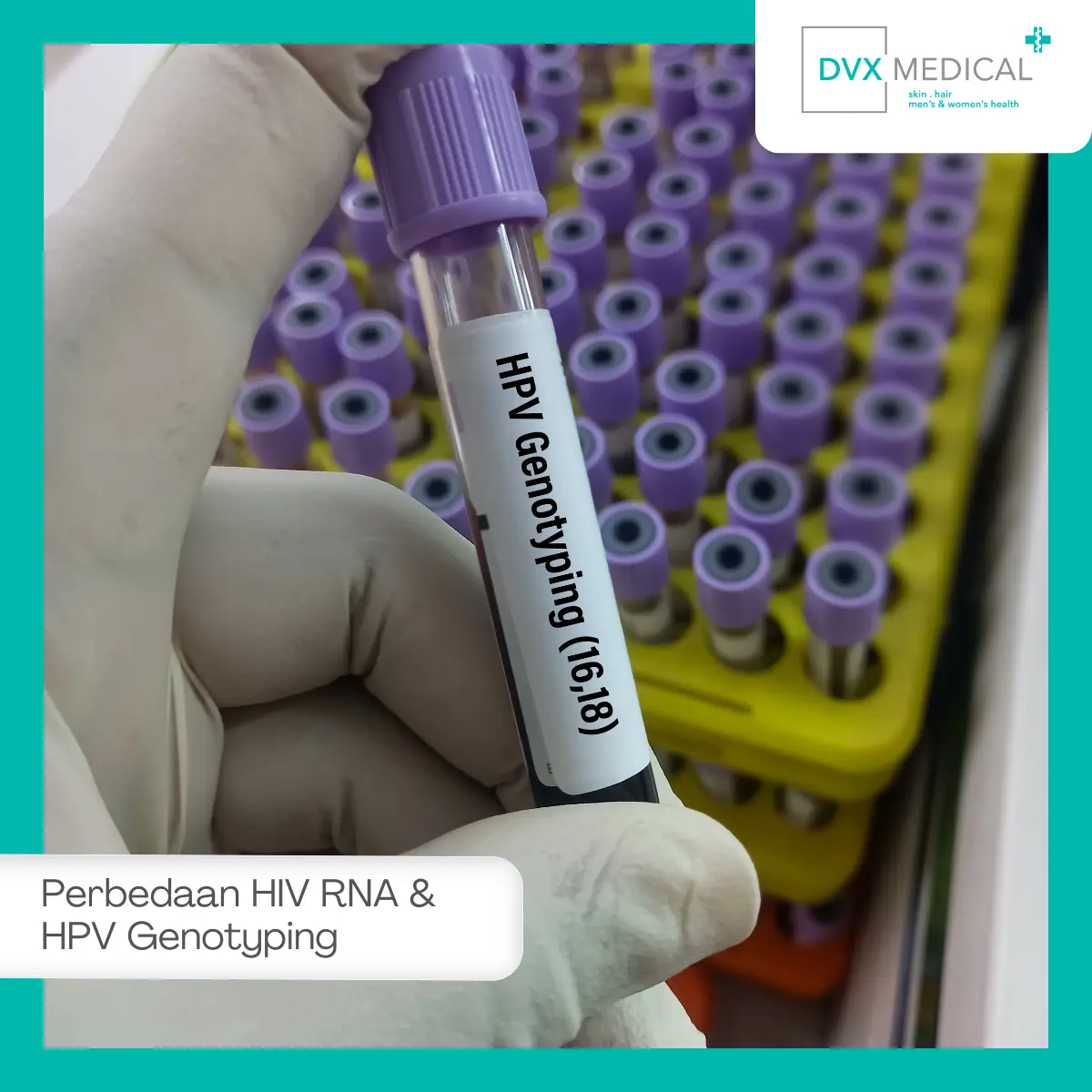 Apakah HIV RNA Test dan HPV Genotyping Perlu Dilakukan Bersamaan?