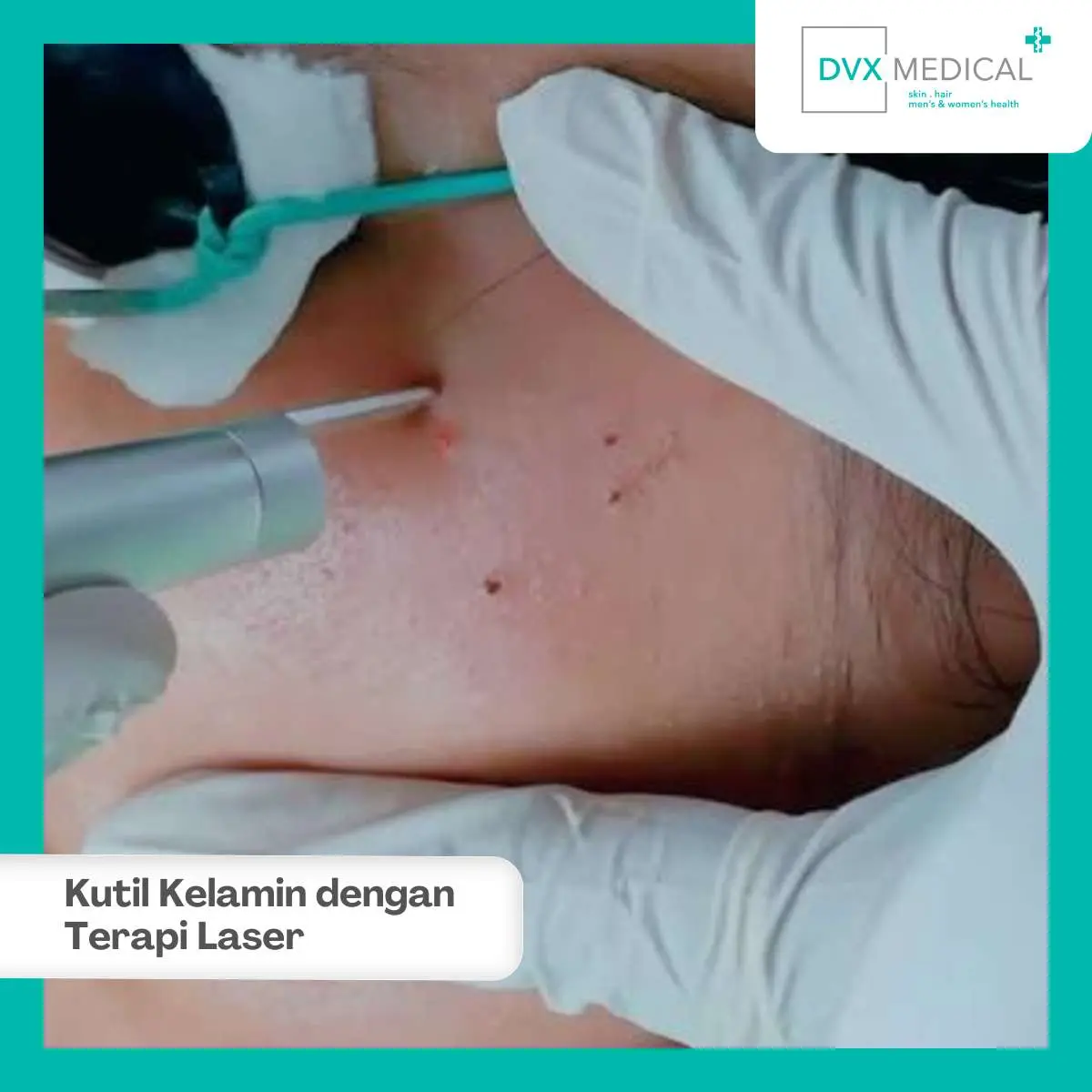 Terapi Laser Kutil Kelamin sebagai Pilihan Penanganan