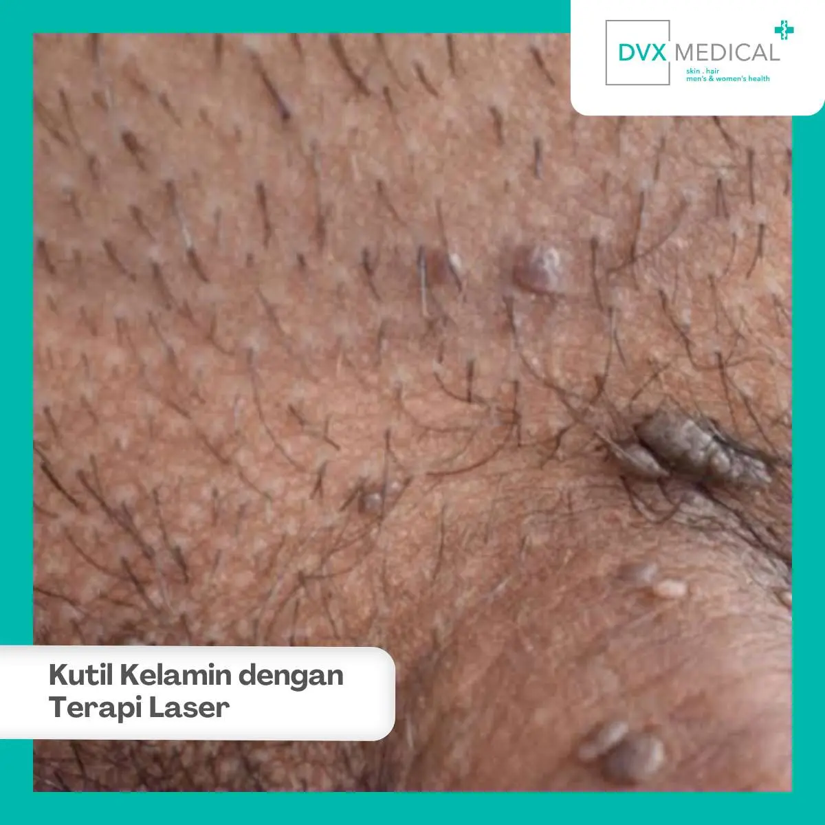 Bagaimana Prosedur Laser Kutil Kelamin di DVX Medical?