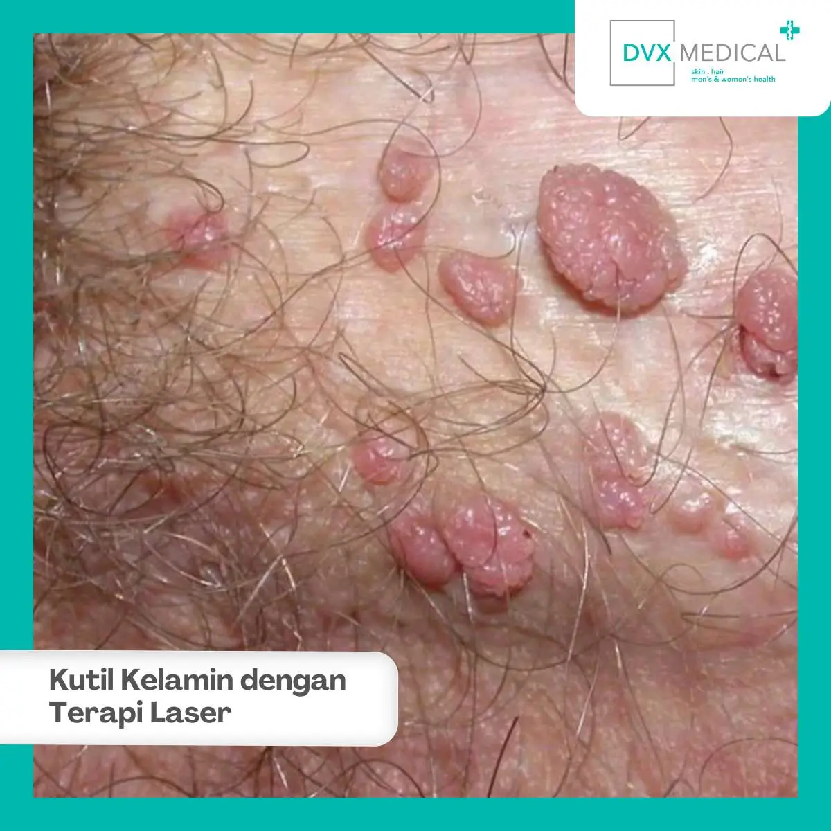 Kenapa Memilih DVX Medical untuk Terapi Laser Kutil Kelamin?