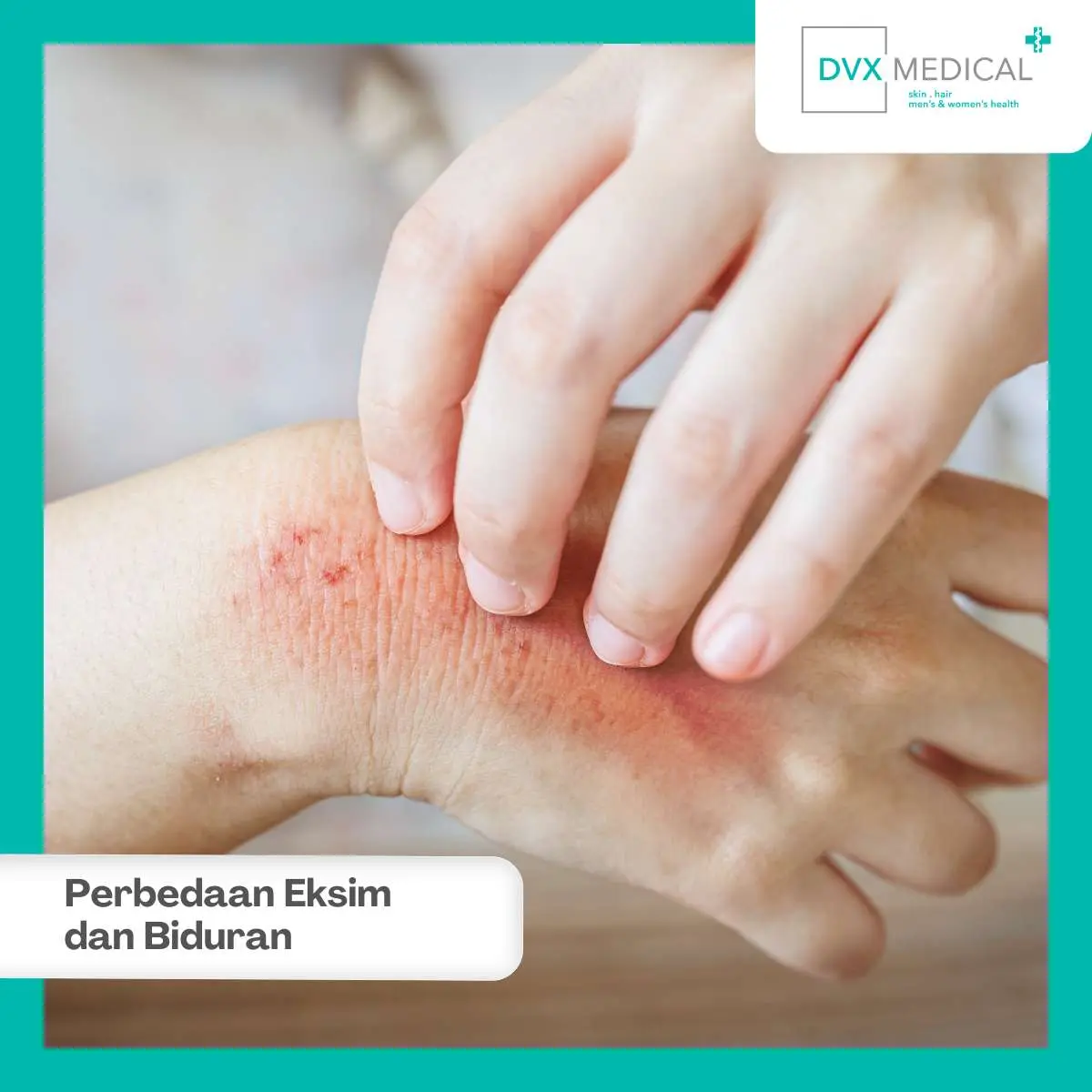 Sama-Sama Gatal, Mengapa Eksim dan Biduran Sering Tertukar?