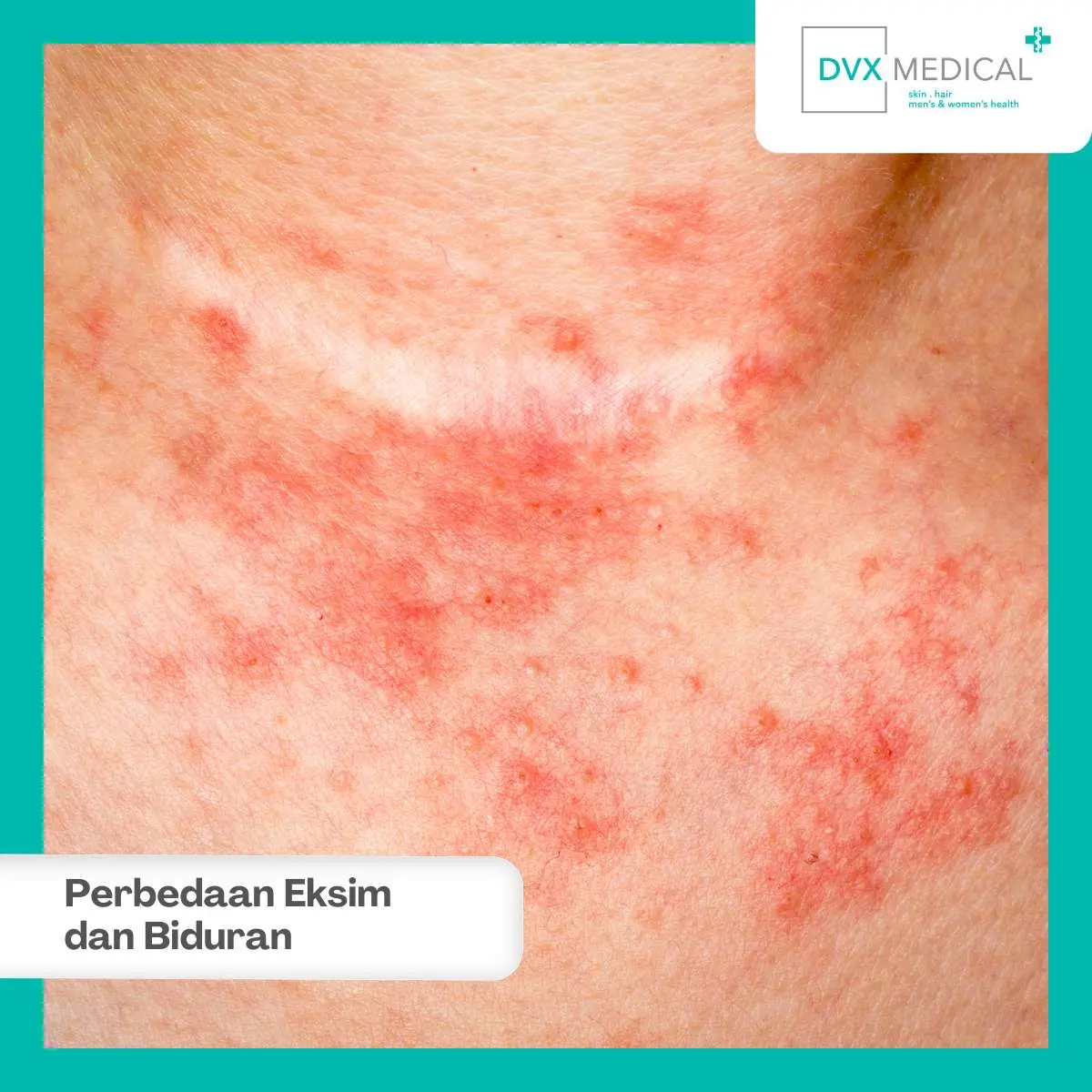 Mengapa Eksim dan Biduran Tidak Bisa Diobati dengan Cara yang Sama?