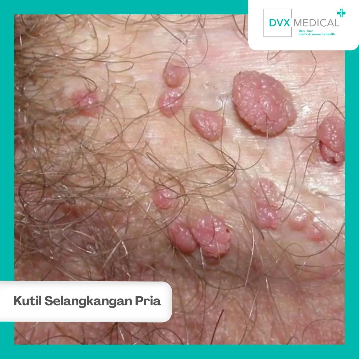 Apa Itu Kutil di Selangkangan Pria?
