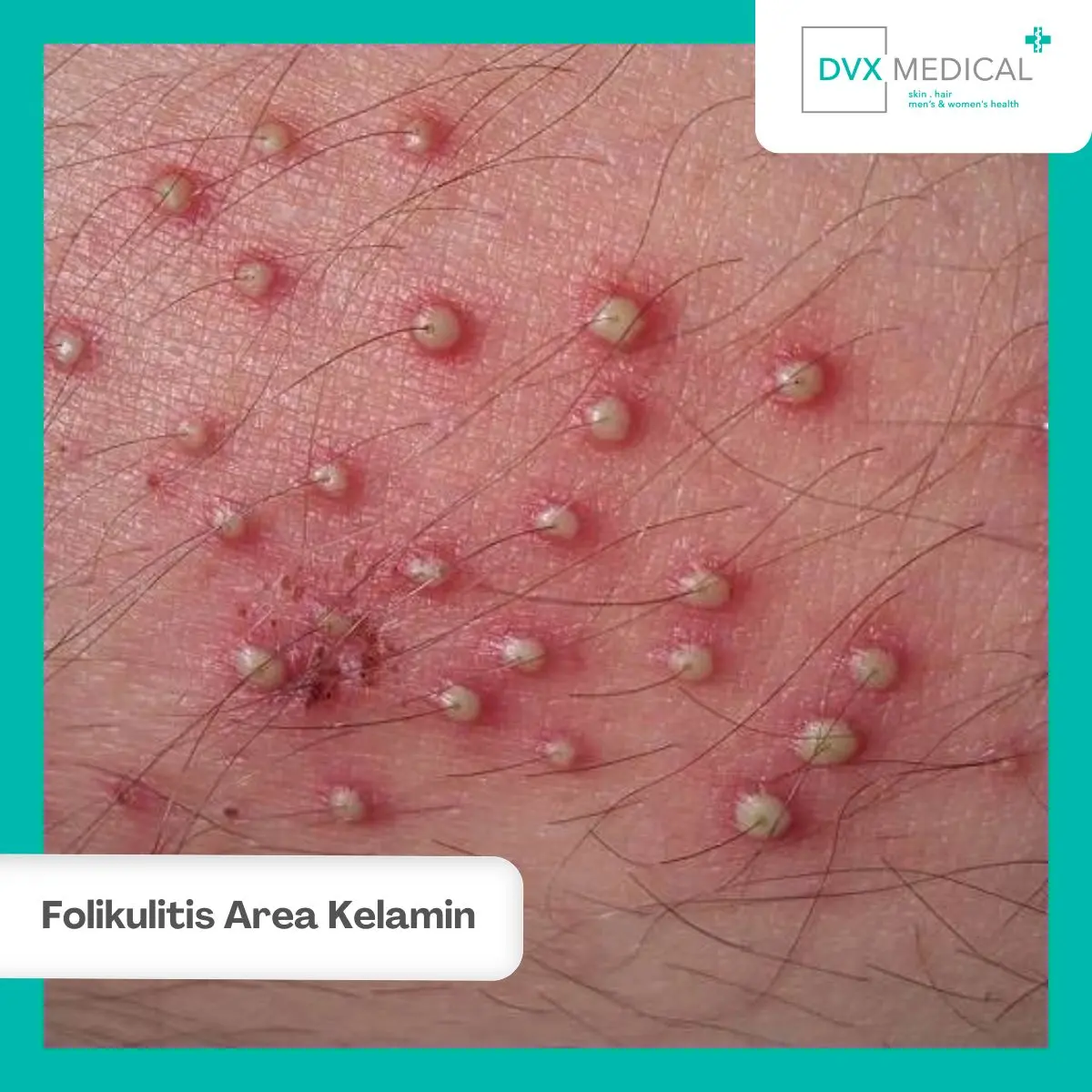 Apa Itu Folikulitis di Area Kelamin?