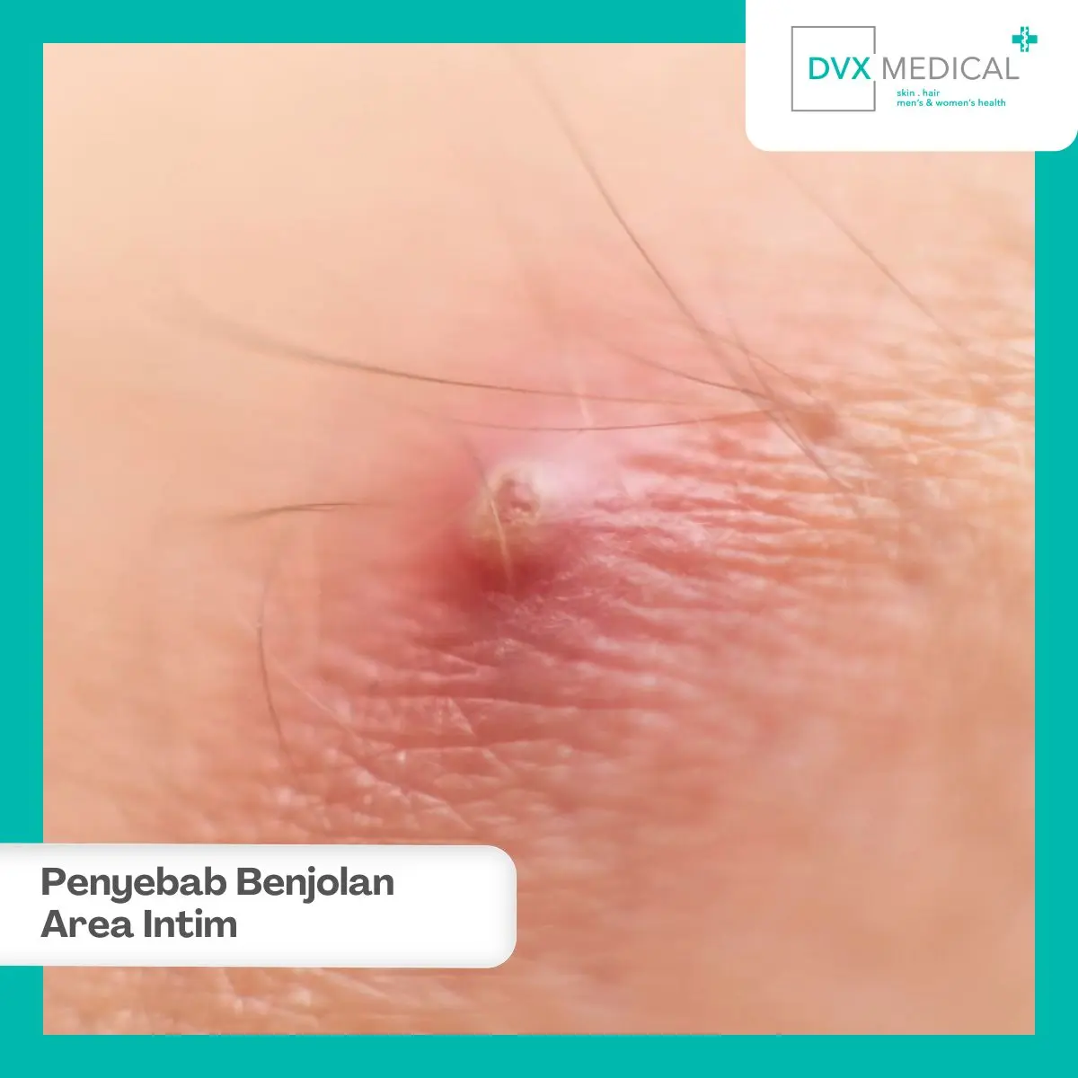 Mengapa Benjolan Bisa Muncul di Area Intim?