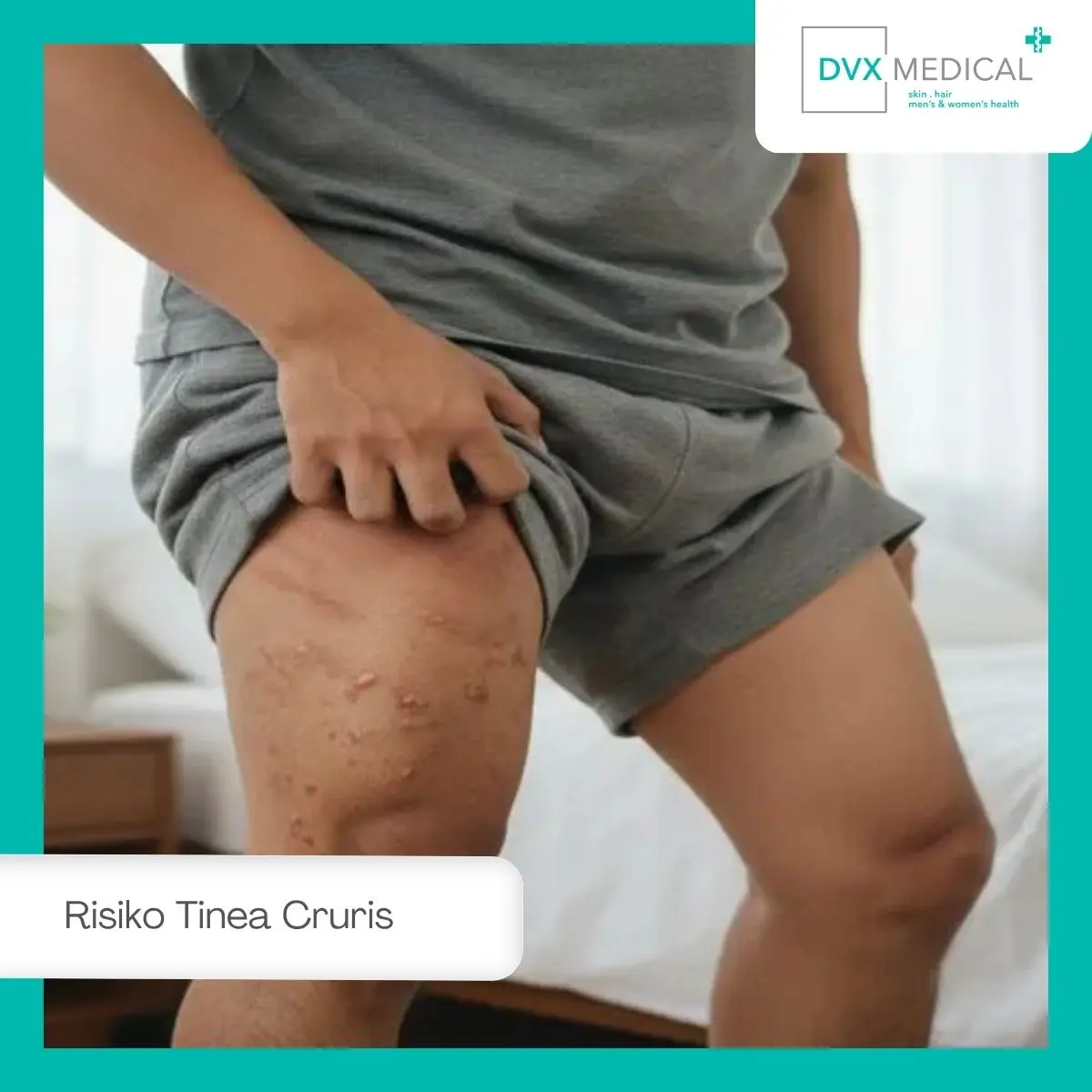Mengapa Tinea Cruris pada Pria Aktif Lebih Mudah Terjadi?