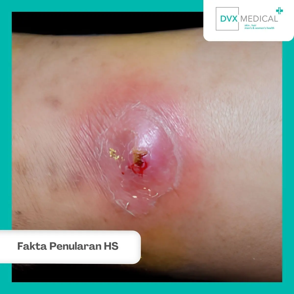 Jadi, Apakah Hidradenitis Suppurativa Menular?