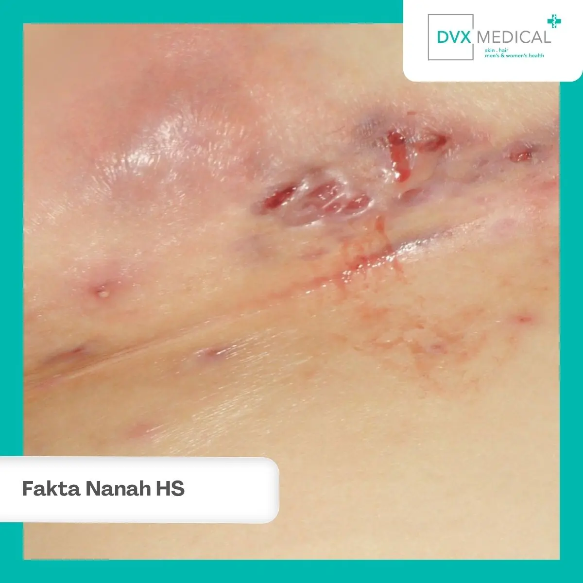 Apakah Nanah dari Hidradenitis Suppurativa Menular?