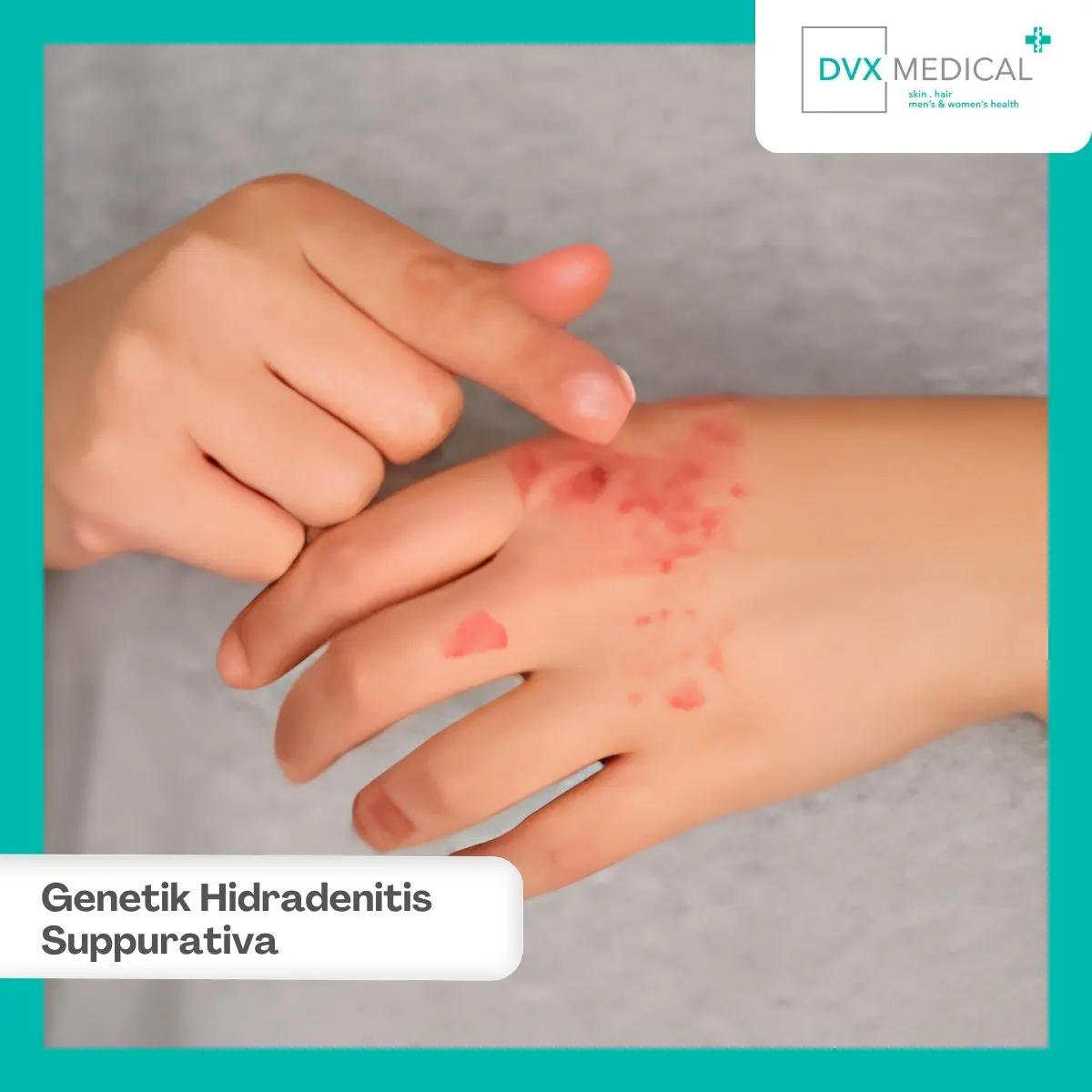 Hidradenitis Suppurativa Tidak Menular, tetapi Bisa Diturunkan?