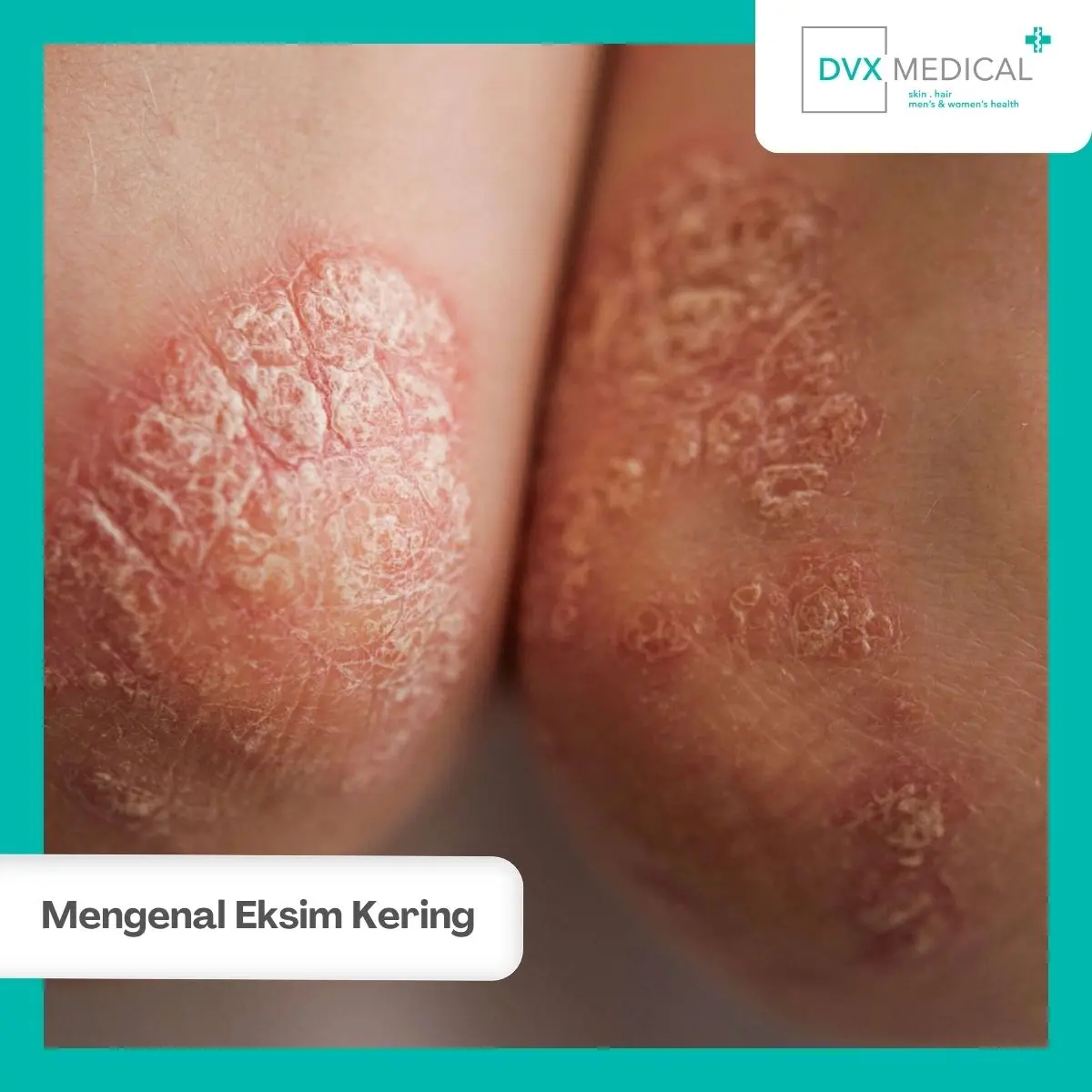 Apa yang Dimaksud dengan Eksim Kering?