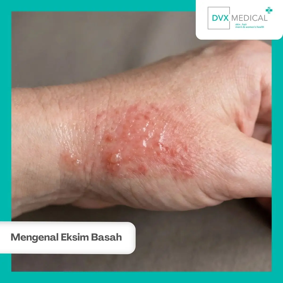 Apa yang Dimaksud dengan Eksim Basah?