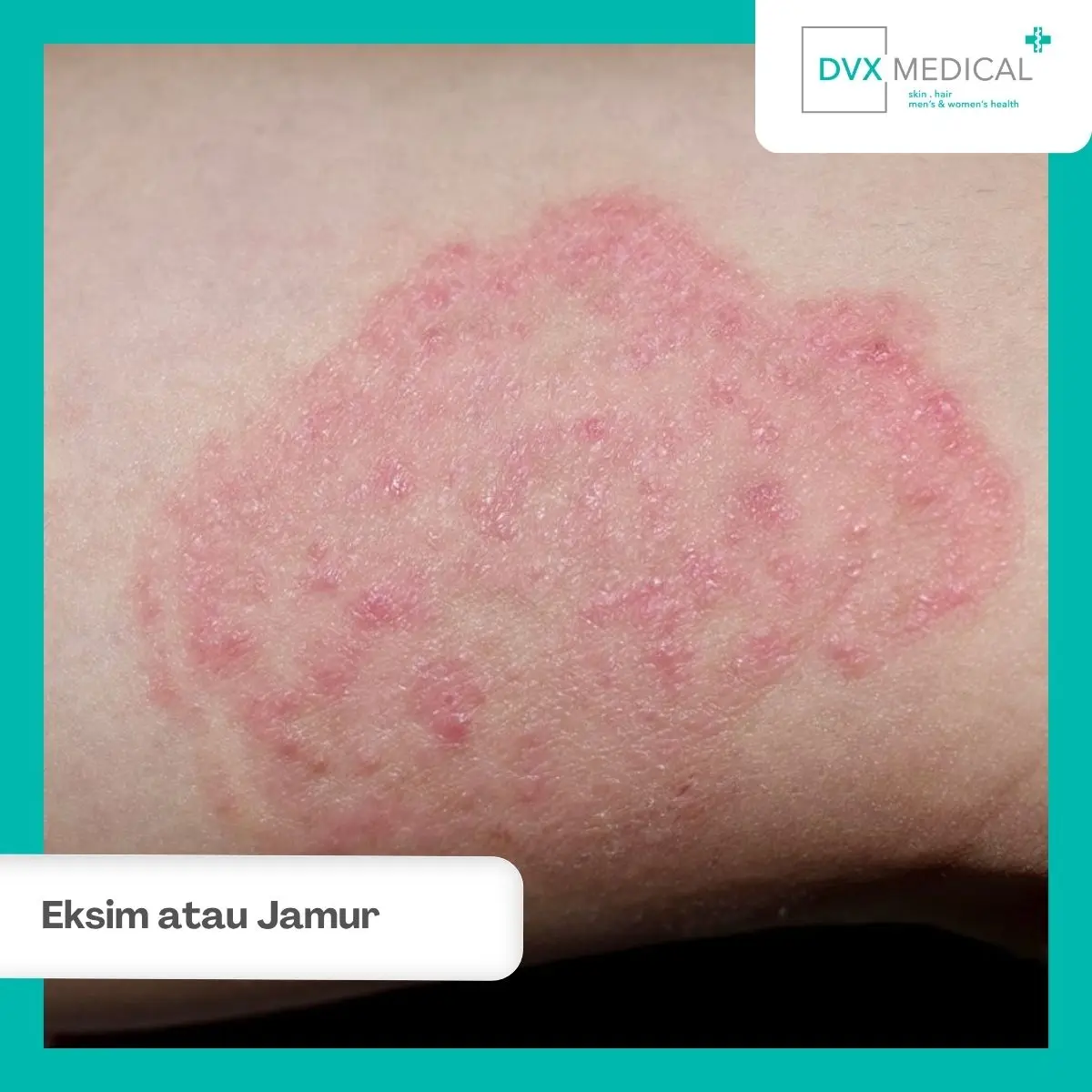 Eksim dan Jamur Kulit: Mana yang Menular?