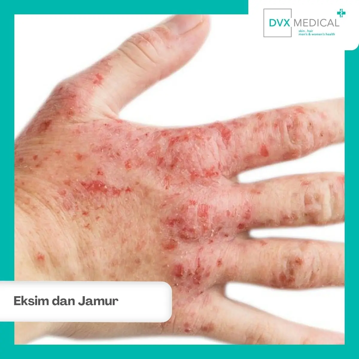 Mengapa Eksim di Leher Bisa Sering Kambuh?