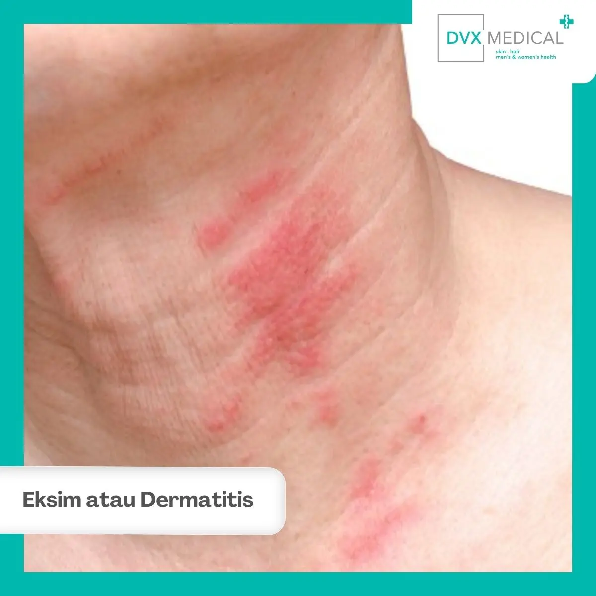 Eksim atau Dermatitis Kontak? Jangan Menebak dari Bentuk Ruam Saja