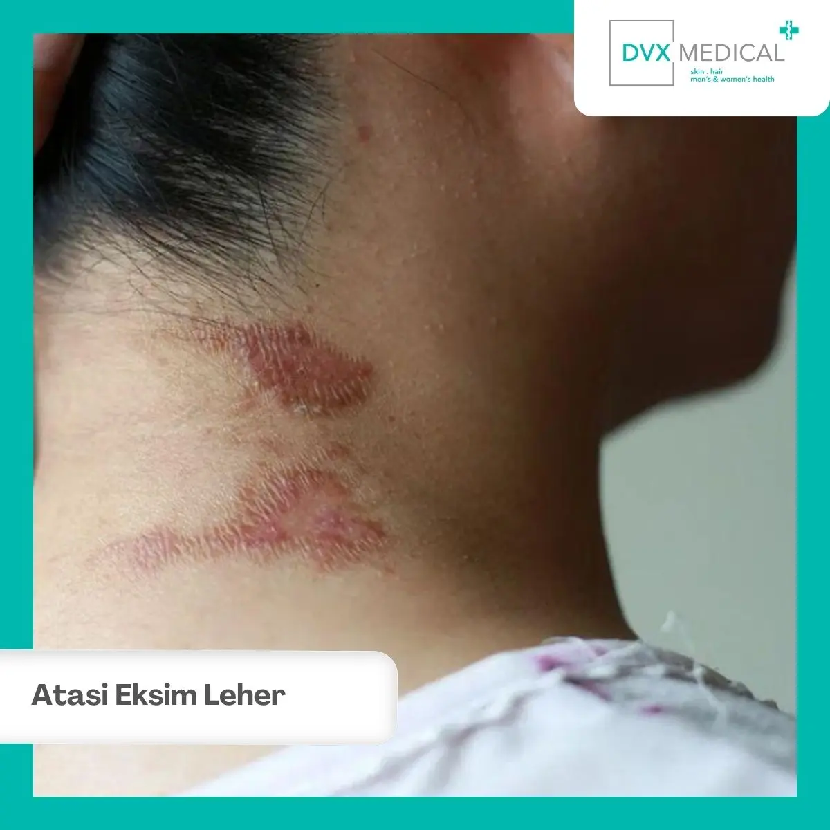 Apa yang Bisa Dilakukan Saat Eksim Leher Kambuh?