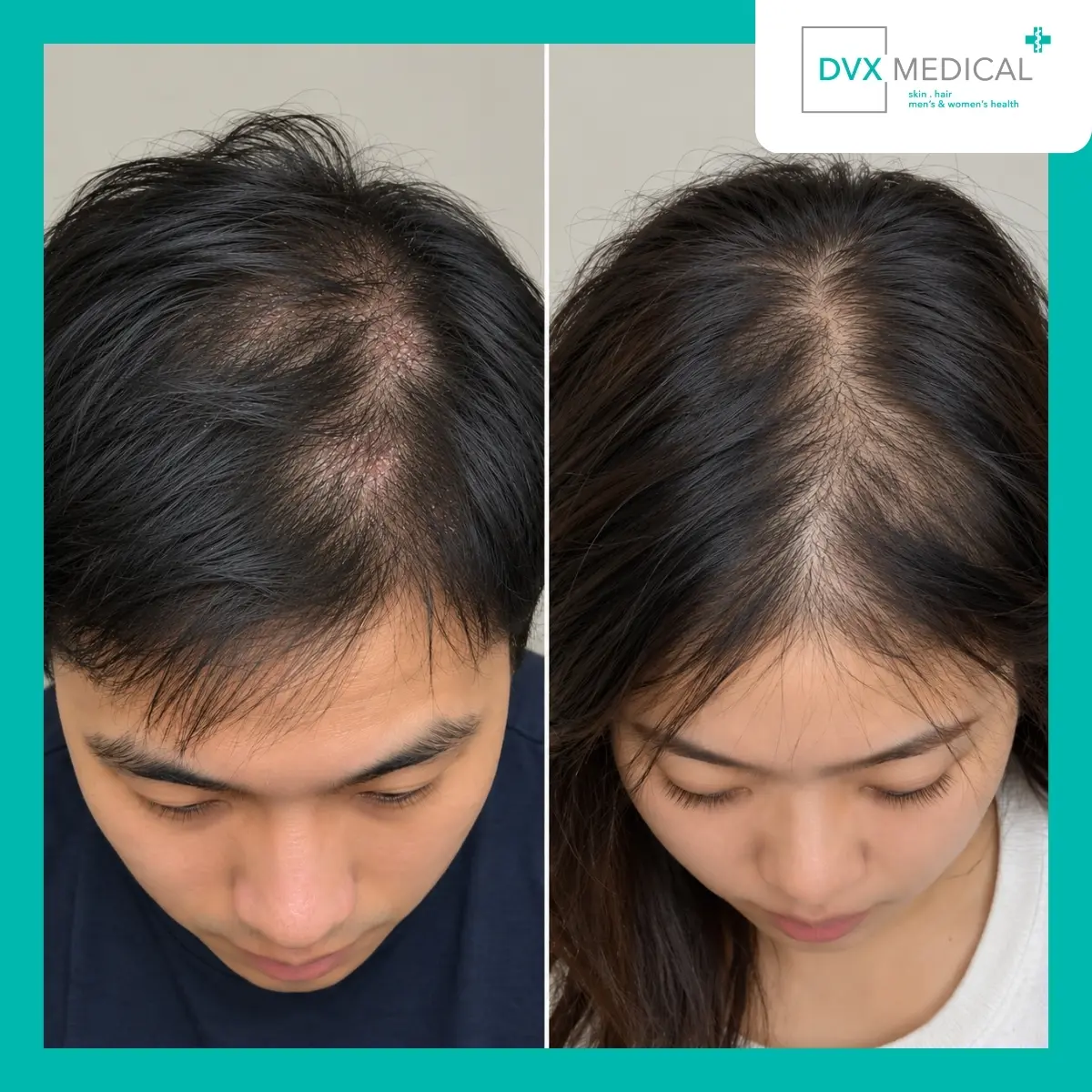 Kondisi yang Menyerupai Alopecia Areata