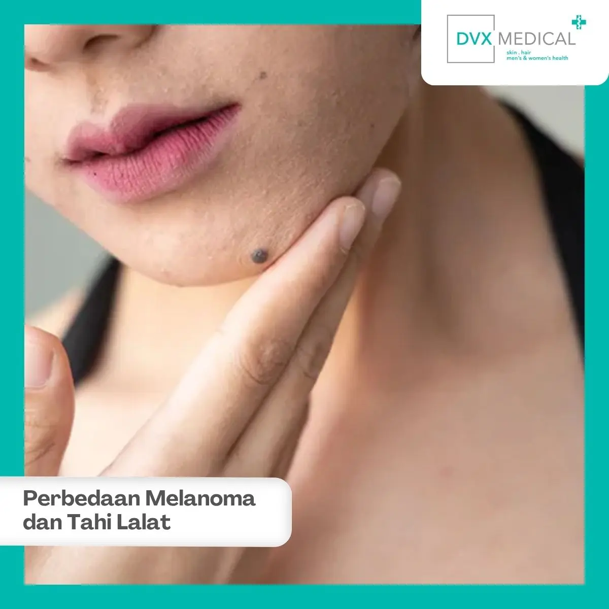Apa Itu Tahi Lalat dan Melanoma?