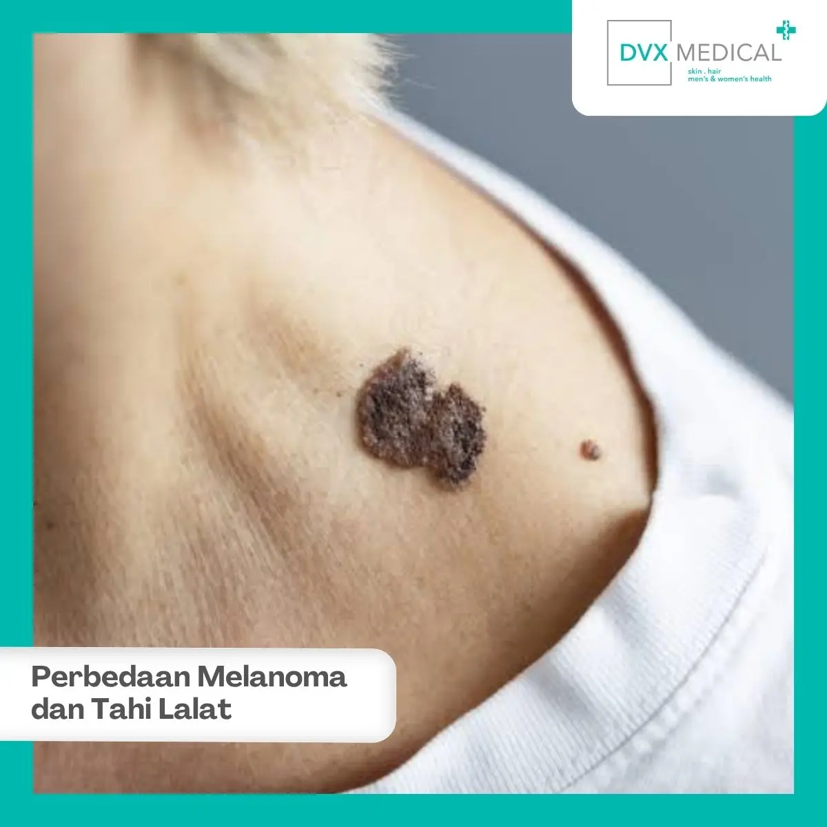 Apakah Tahi Lalat yang Membesar Selalu Berarti Melanoma?