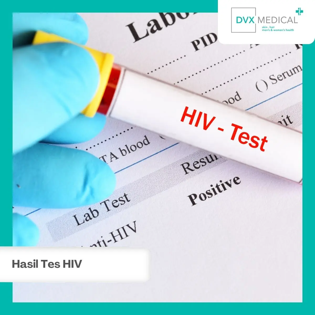 Hasil Tes HIV Non-Reaktif: Langkah yang Perlu Anda Lakukan
