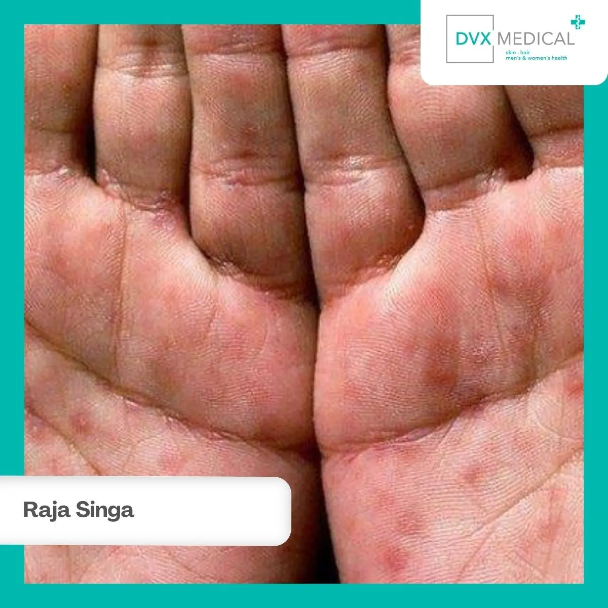 Kapan Raja Singa Bisa Menyerang Sistem Saraf?