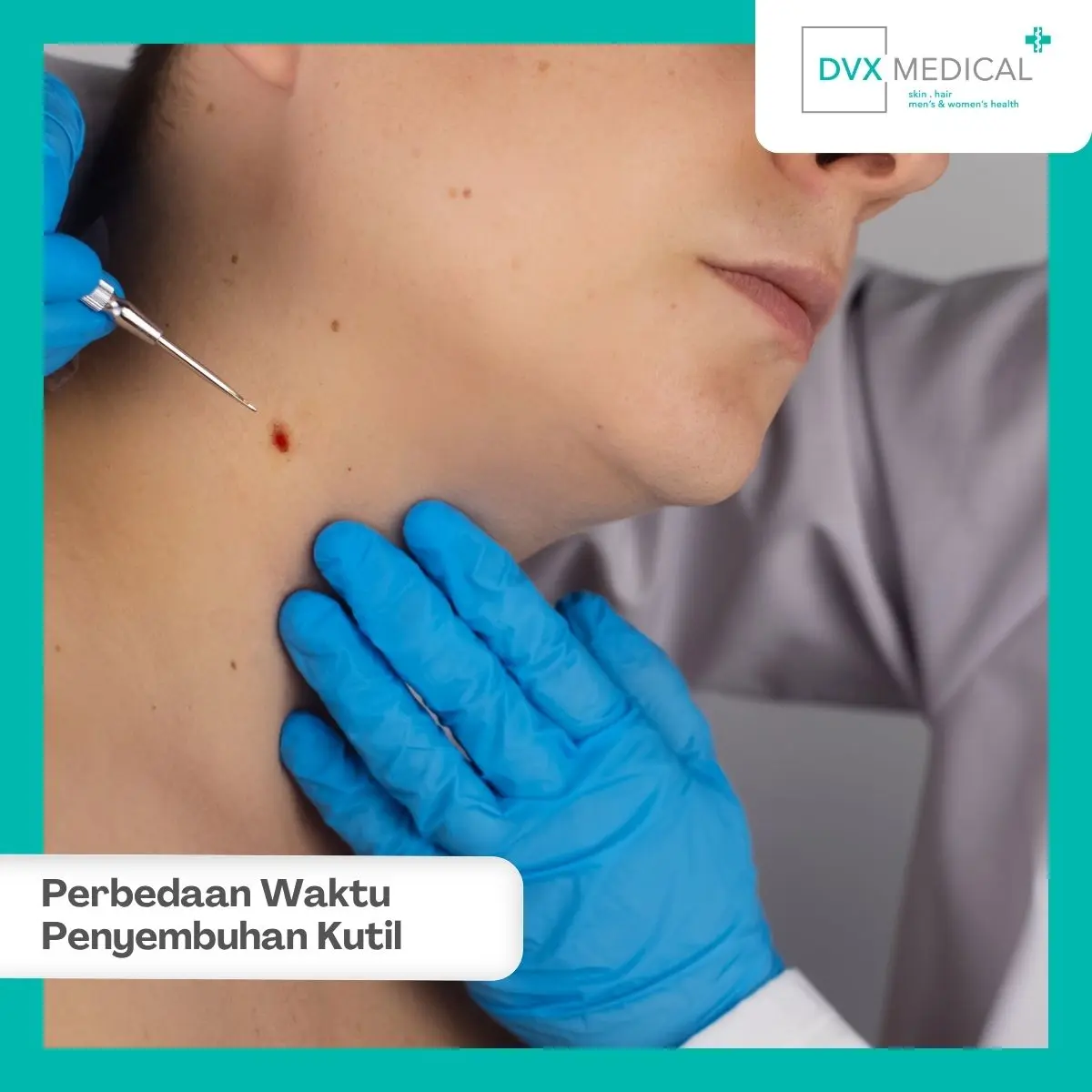 Bagaimana Prosedur Laser Kutil Kelamin di DVX Medical?