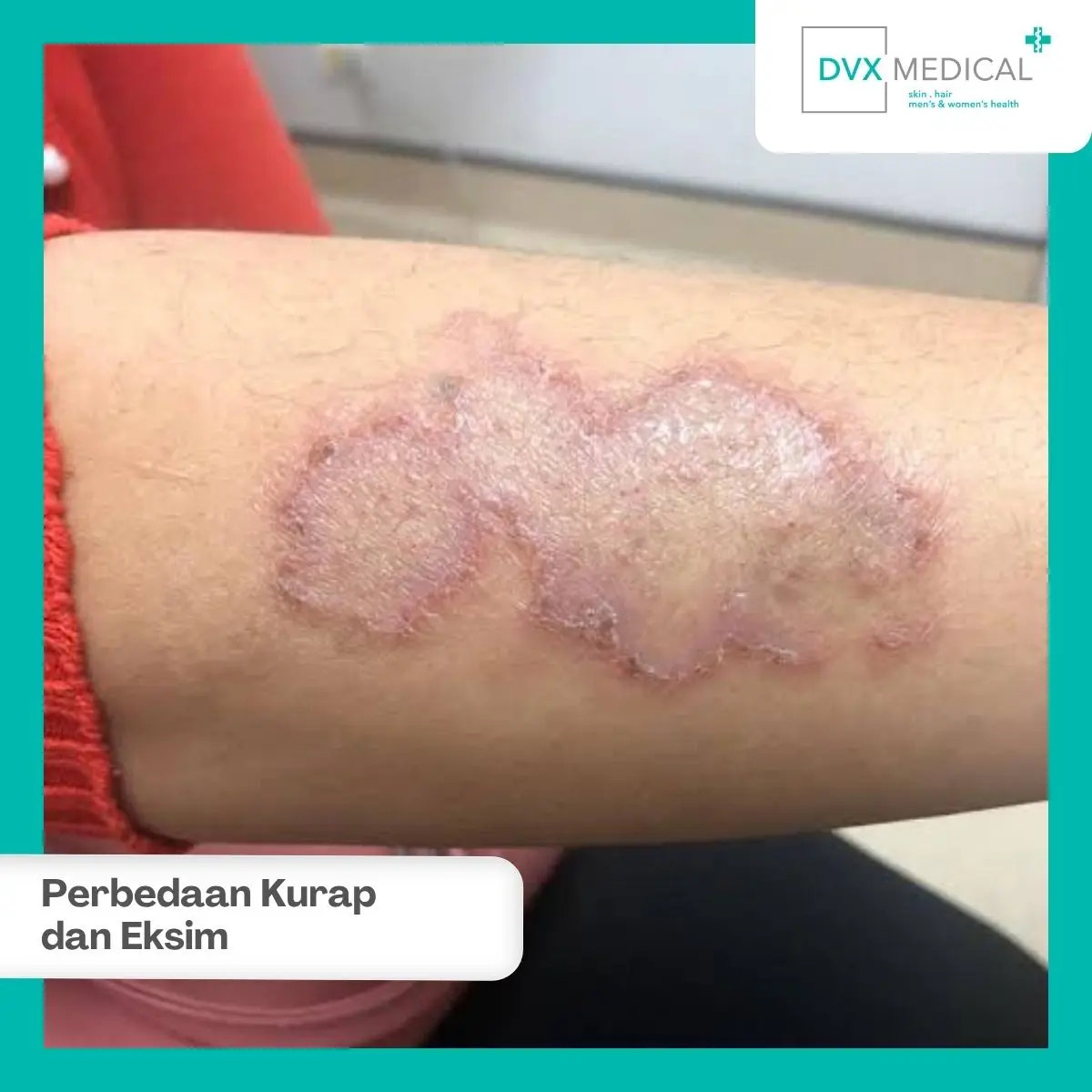 Apakah Kurap dan Eksim Sama-Sama Menular?