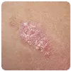 Psoriasis