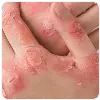 Eczema