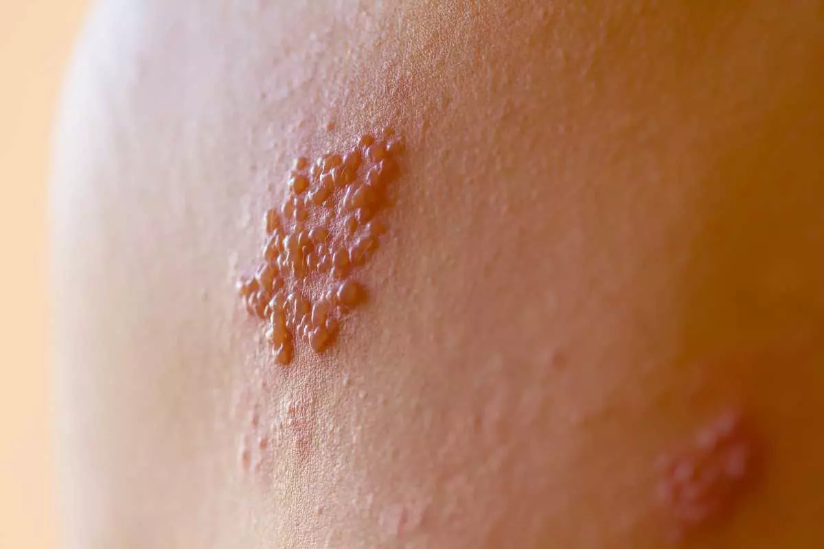 Bahaya Penyakit Herpes Simpleks
