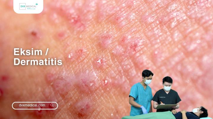 Eksim / Dermatitis