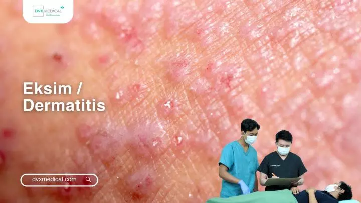 Eksim / Dermatitis