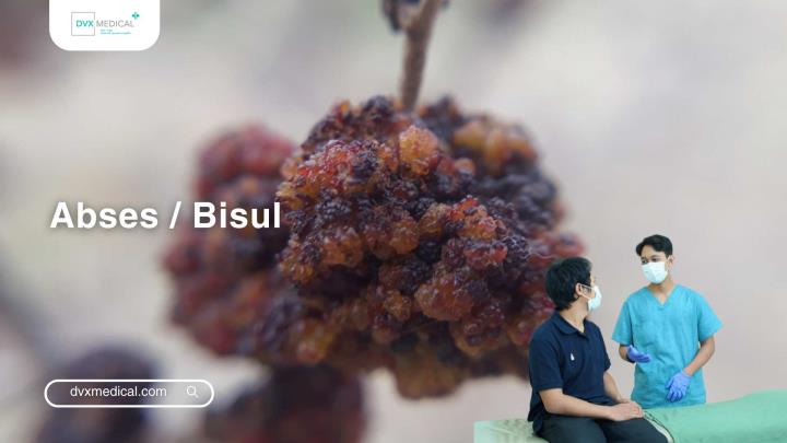 Abses / Bisul