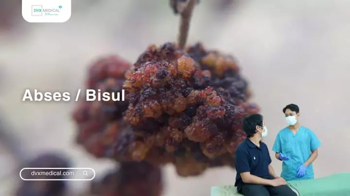Abses / Bisul