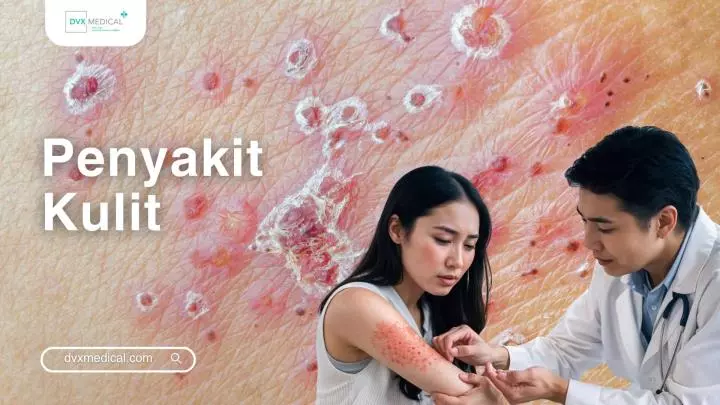 Infeksi Virus Herpes Simpleks (Herpes Simplex Infections)